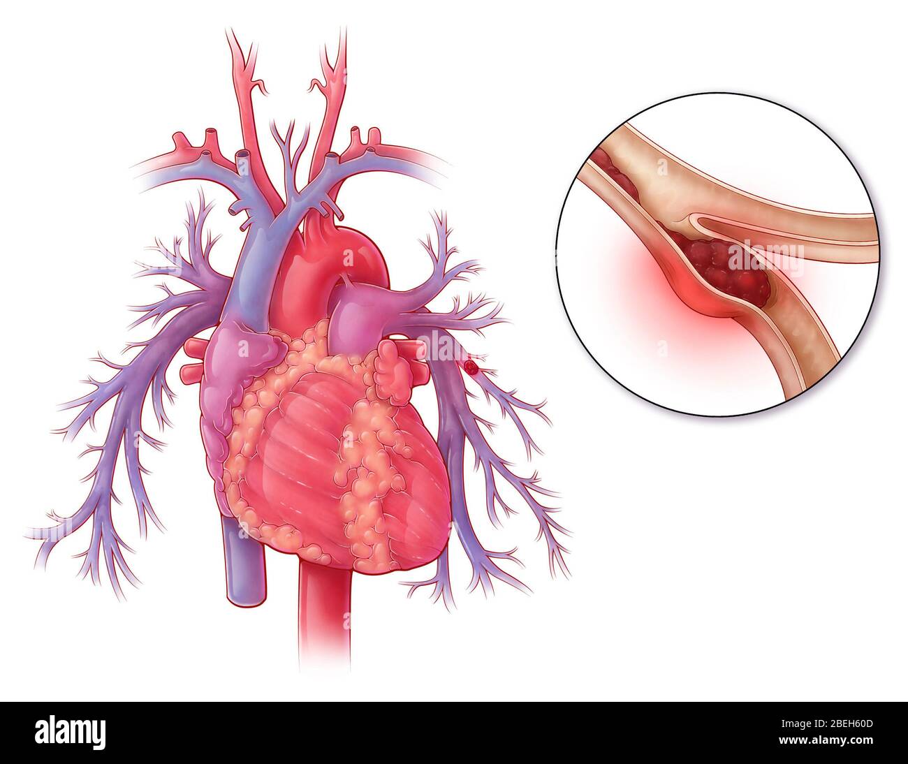 Embolisme pulmonaire, illustration Banque D'Images