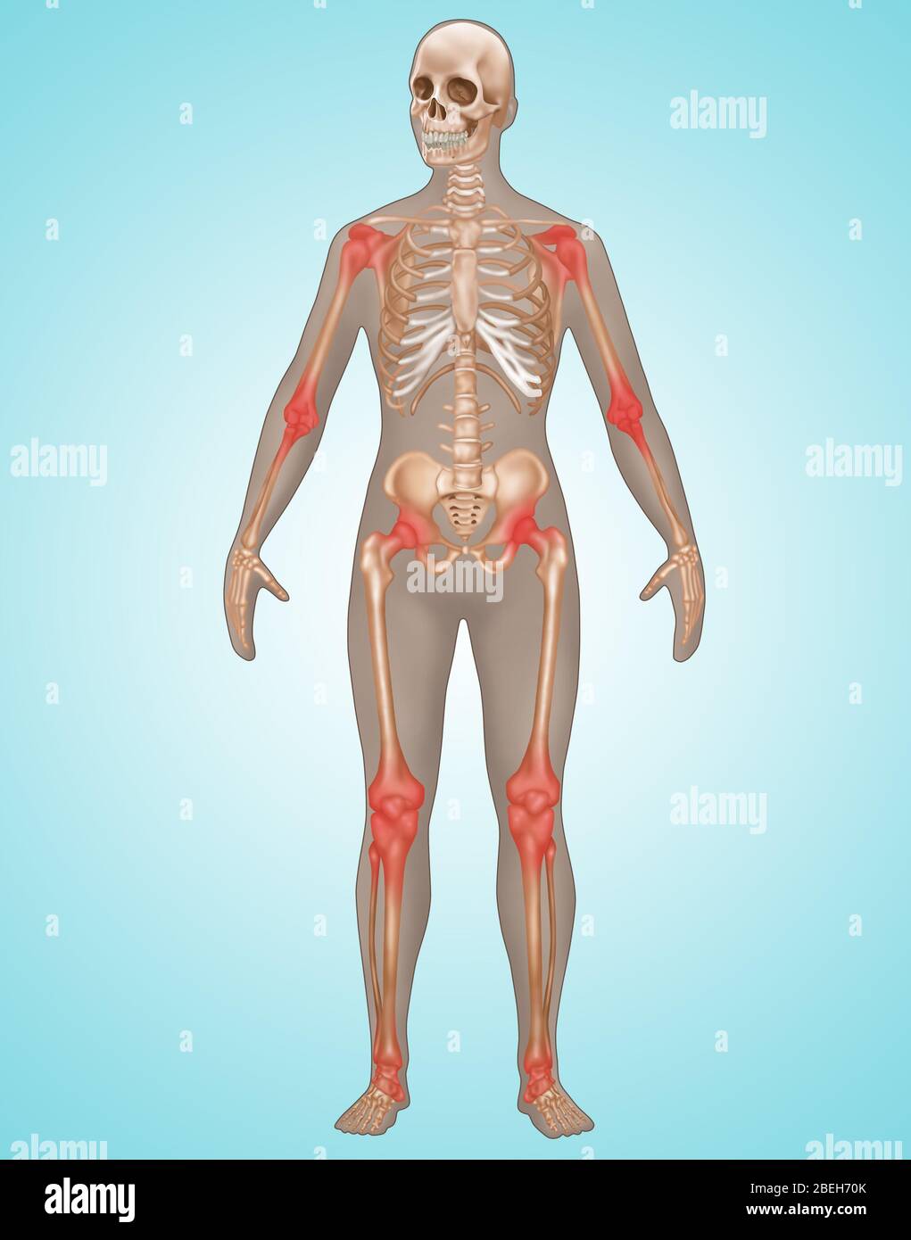 Inflammation articulaire, illustration Banque D'Images