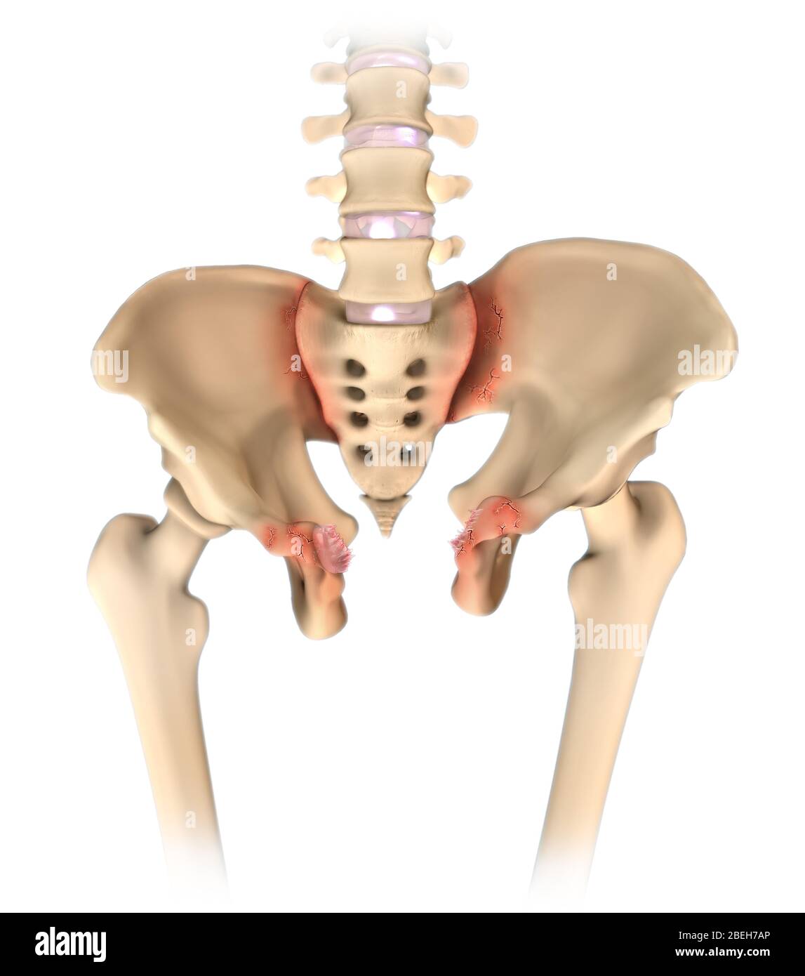 Ouvrir le livre fracture pelvienne Banque D'Images