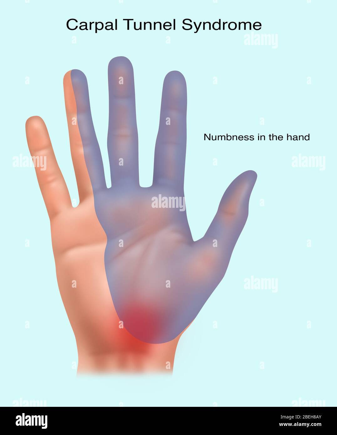 Illustration du canal carpien. Le syndrome du canal carpien se produit lorsque le nerf médian est comprimé au poignet, et des résultats dans la douleur et l'engourdissement. L'engourdissement se produit dans la zone bleue de la main. Banque D'Images