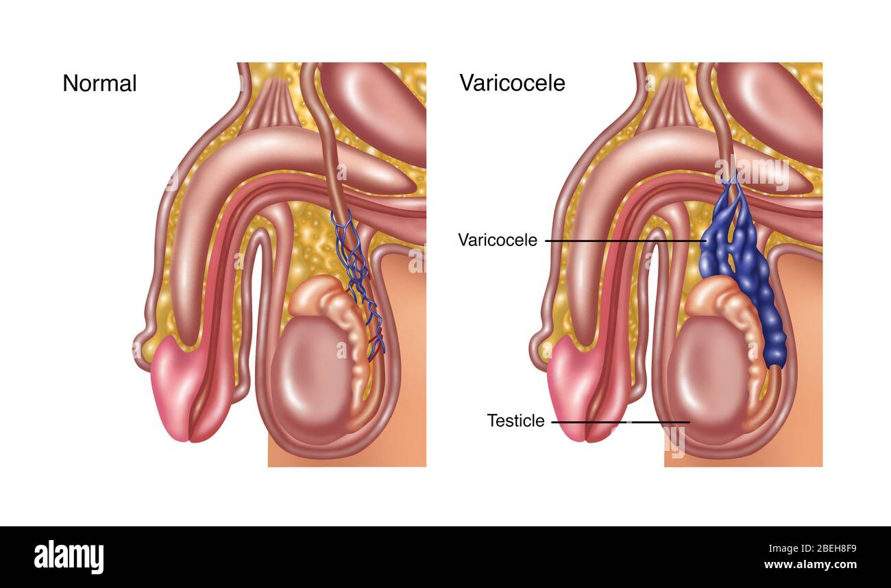 Varicocele Banque De Photographies Et D Images A Haute Resolution Alamy