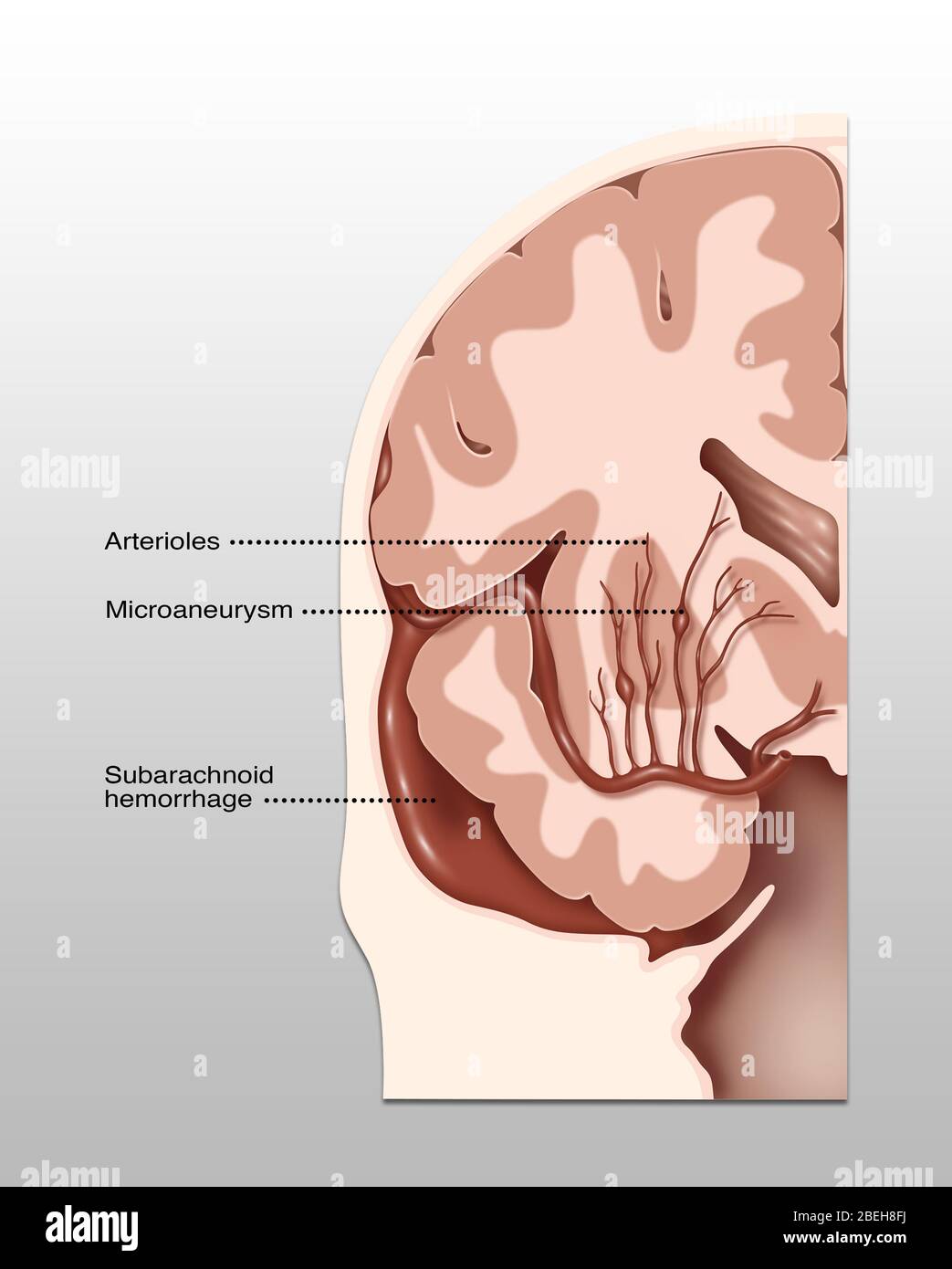 Emplacements des accidents vasculaires cérébraux hémorragiques, illustration Banque D'Images