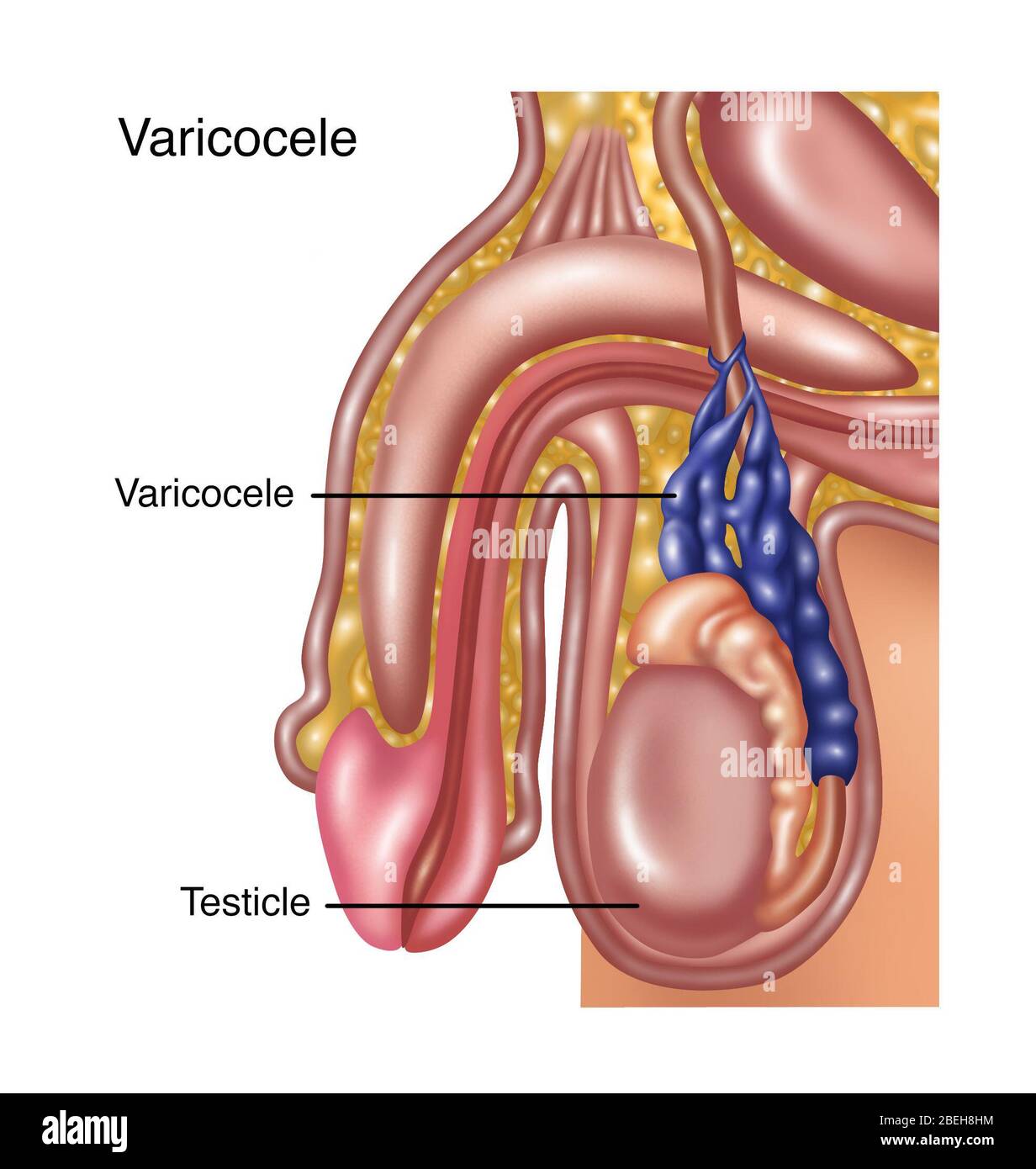 Varicocèle scrotale, illustration Banque D'Images