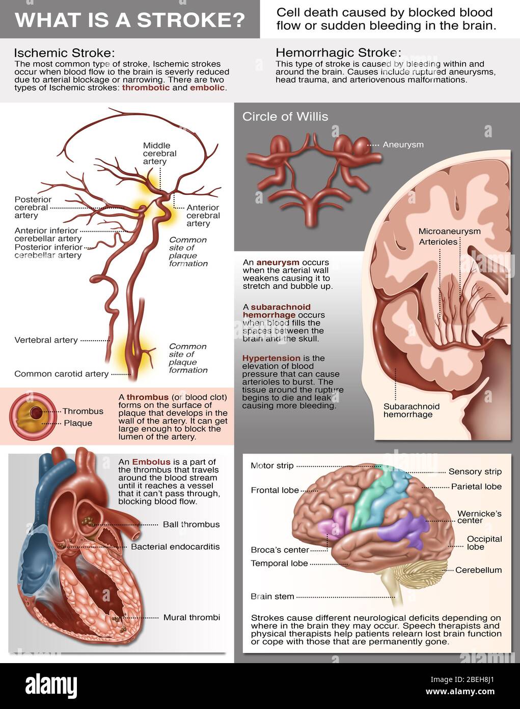 Brochure d'information sur les accidents vasculaires cérébraux, illustration Banque D'Images
