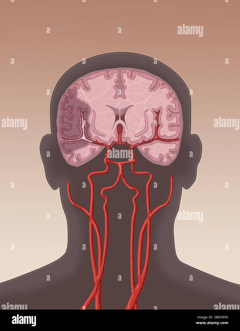 Accident ischémique cérébral. Dans un accident ischémique vasculaire cérébral, un caillot bloque le flux sanguin vers une zone du cerveau. Banque D'Images
