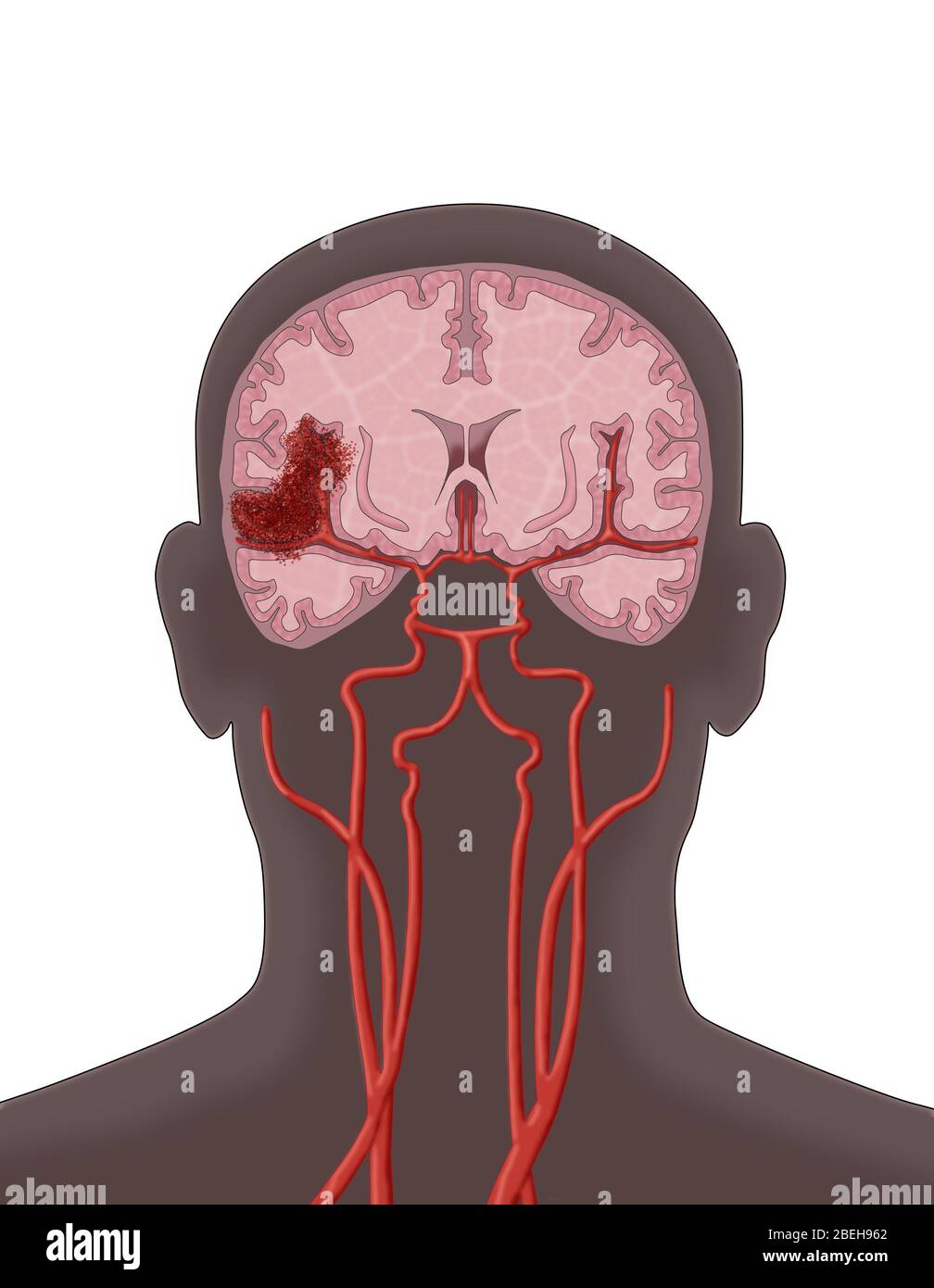 L'accident vasculaire cérébral hémorragique, illustration Banque D'Images