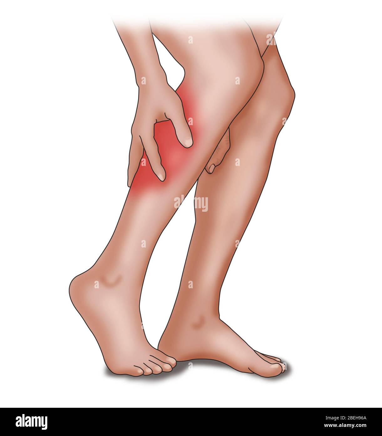 Crampe de jambe causes communes, Illustration Banque D'Images