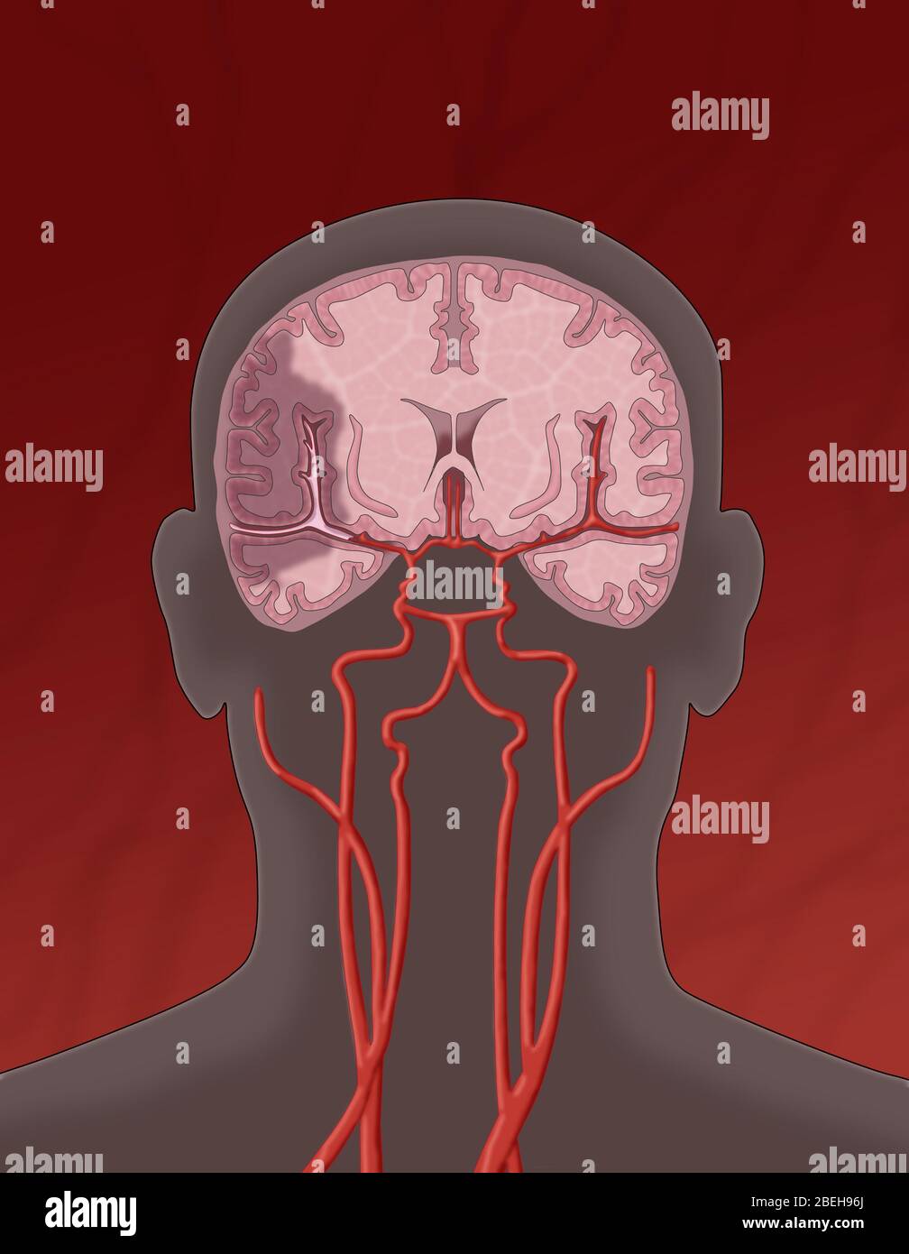 Accident ischémique cérébral. Dans un accident ischémique vasculaire cérébral, un caillot bloque le flux sanguin vers une zone du cerveau. Banque D'Images