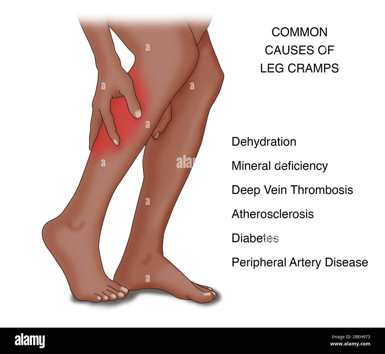 Crampe de jambe causes communes, Illustration Banque D'Images