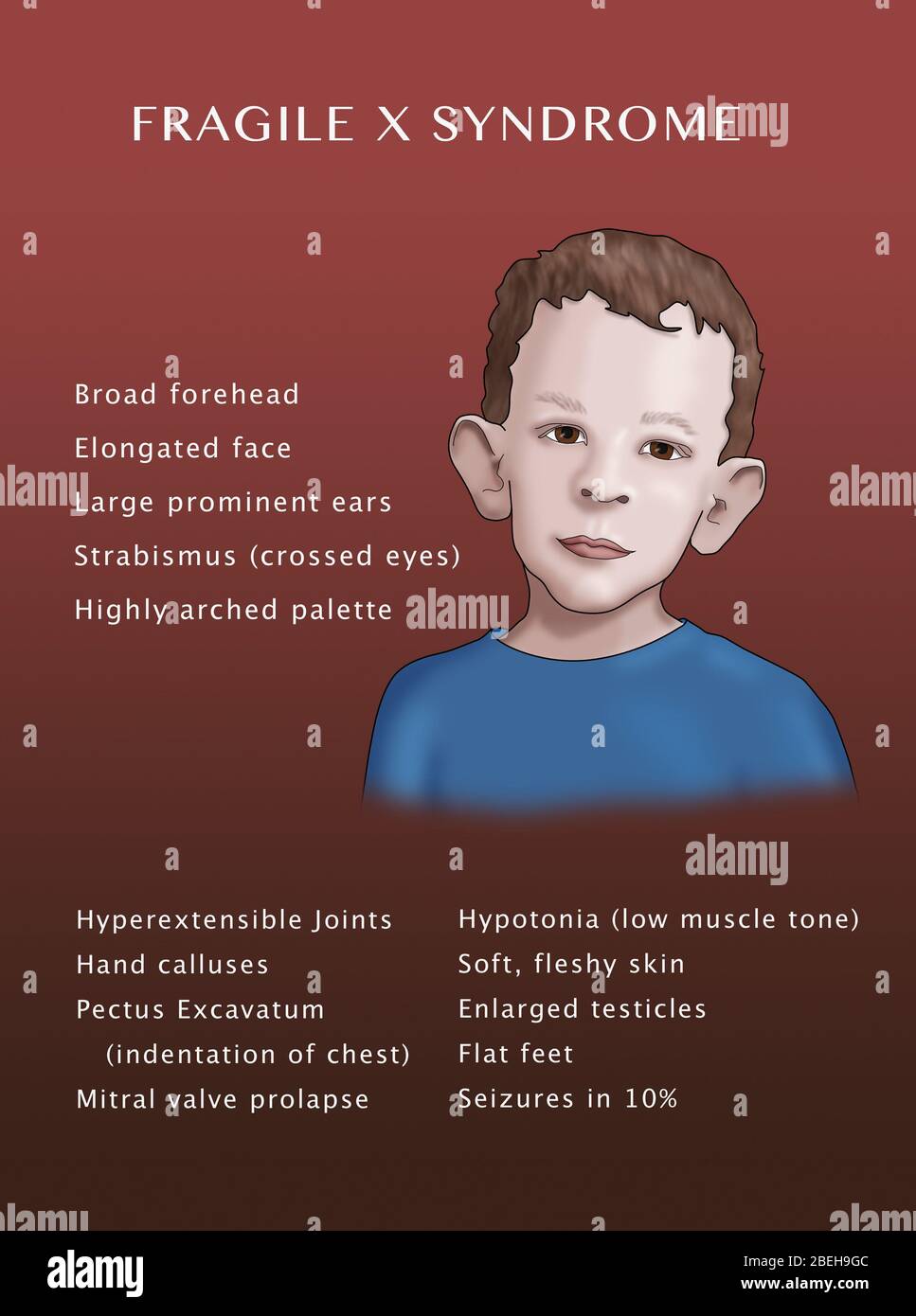 Symptômes du syndrome du X fragile. Illustration. Banque D'Images