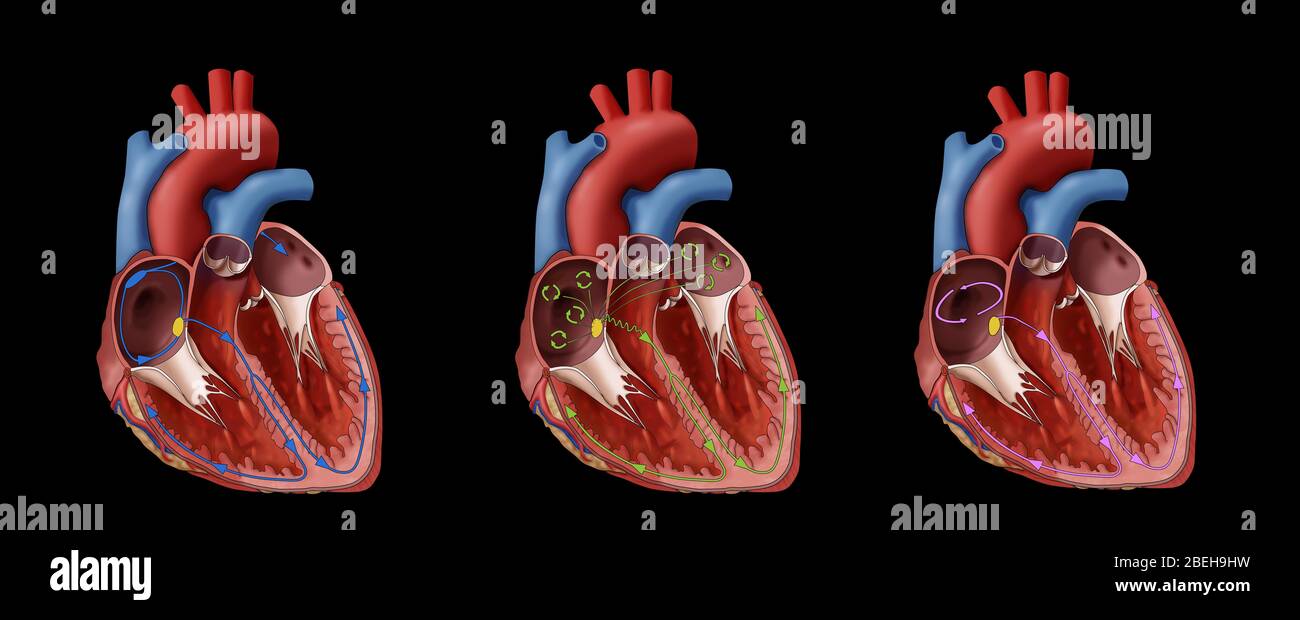 Coeur, Fib et Flutter auriculaire, Illustration Banque D'Images