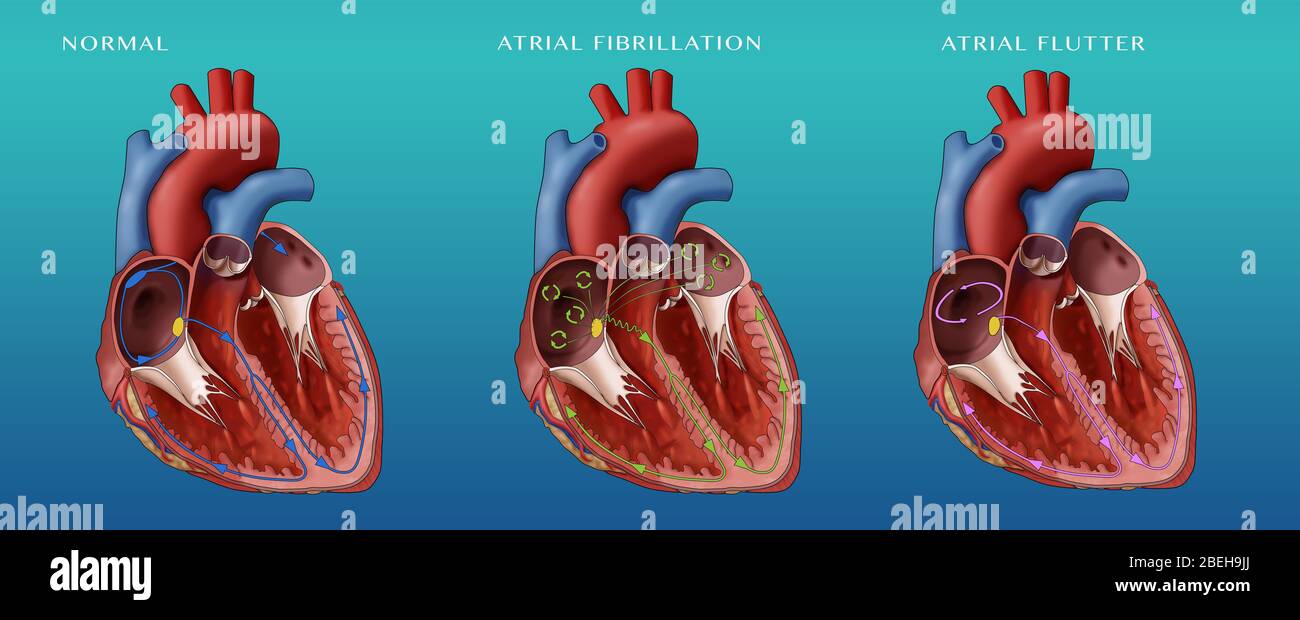 Coeur, Fib et Flutter auriculaire, Illustration Banque D'Images