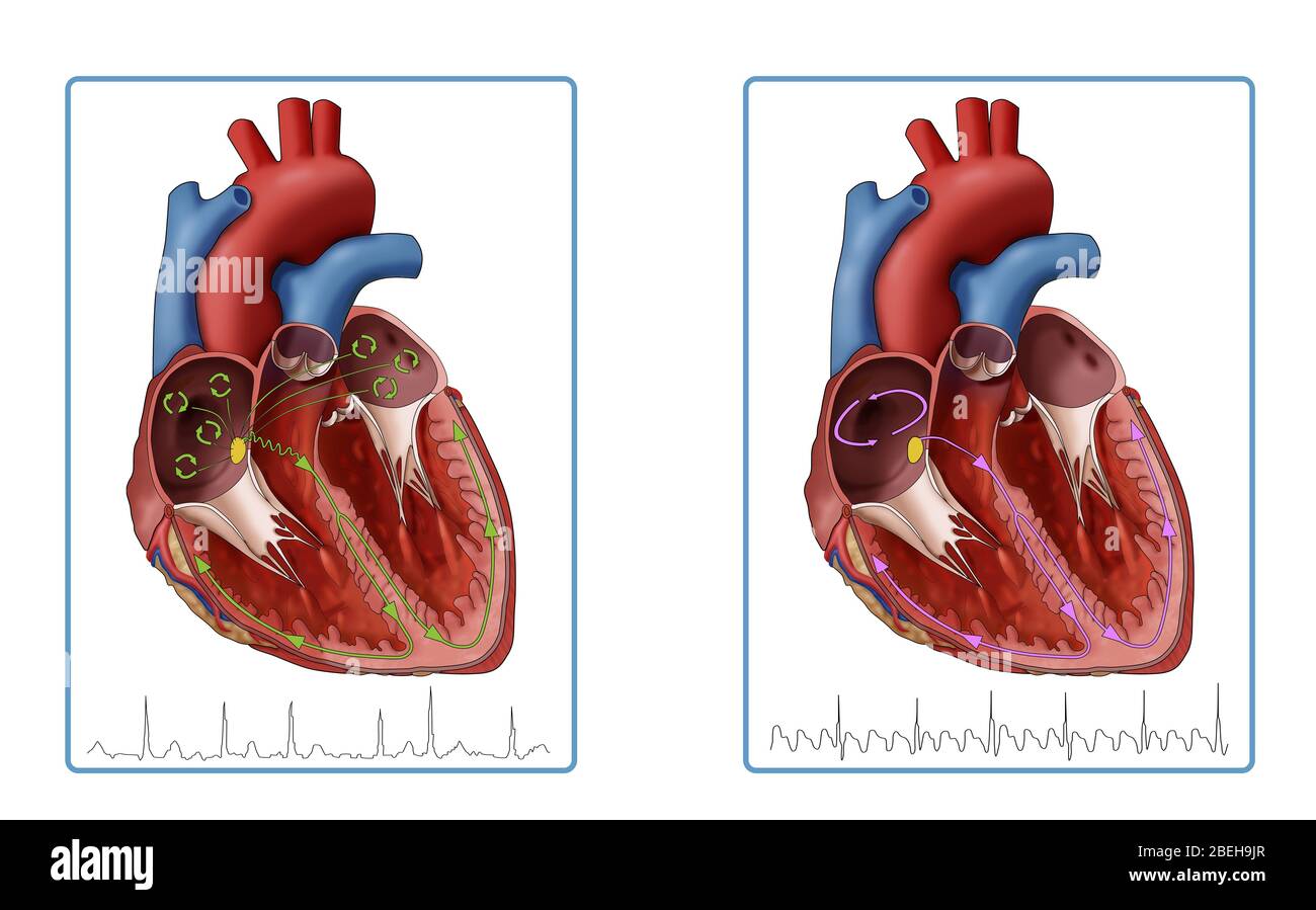 Fibrillation et flutter atriaux, illustration Banque D'Images