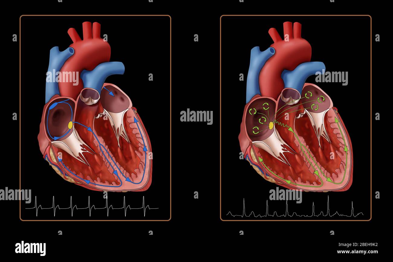 Cœur, fibrillation auriculaire et EKG, illustration Banque D'Images