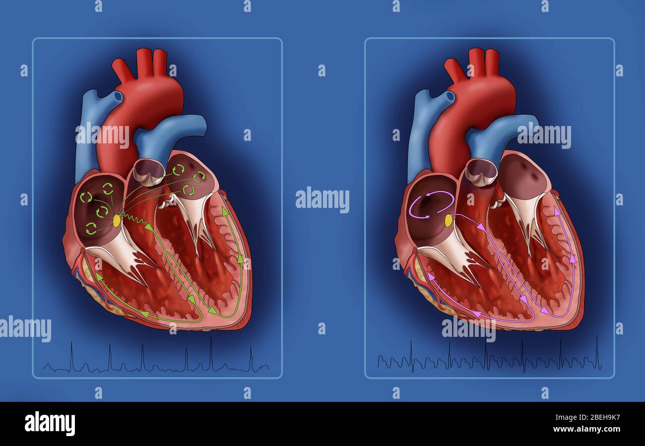 Fibrillation et flutter atriaux, illustration Banque D'Images