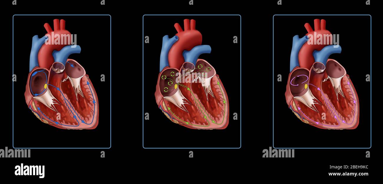 Illustration comparant un muscle cardiaque avec un battement de coeur normal et des battements irréguliers. Montrant un cœur normal (gauche), un cœur avec fibrillation auriculaire (centre) et un cœur avec flutter auriculaire (droite). Comme le montre l'illustration de fibrillation auriculaire (AFib), les signaux électriques désorganisés (cercles verts) proviennent du nœud sa (point jaune). Avec le flutter auriculaire, les signaux électriques se déplacent autour et autour de l'oreillette (cercle rose) ; ces signaux de ciautour rendent l'oreillette trop rapide. Banque D'Images