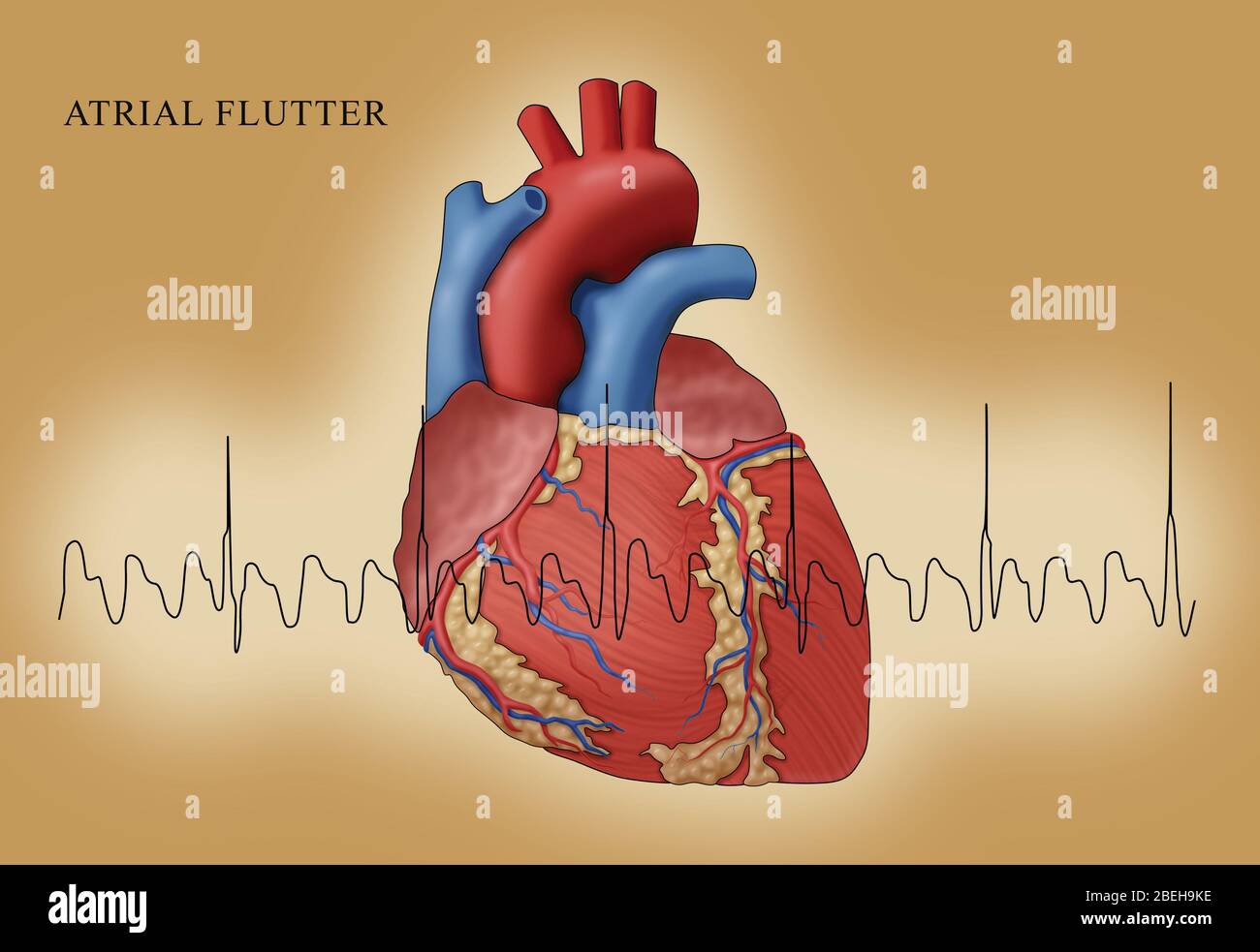 Flutter auriculaire avec EKG, illustration Banque D'Images