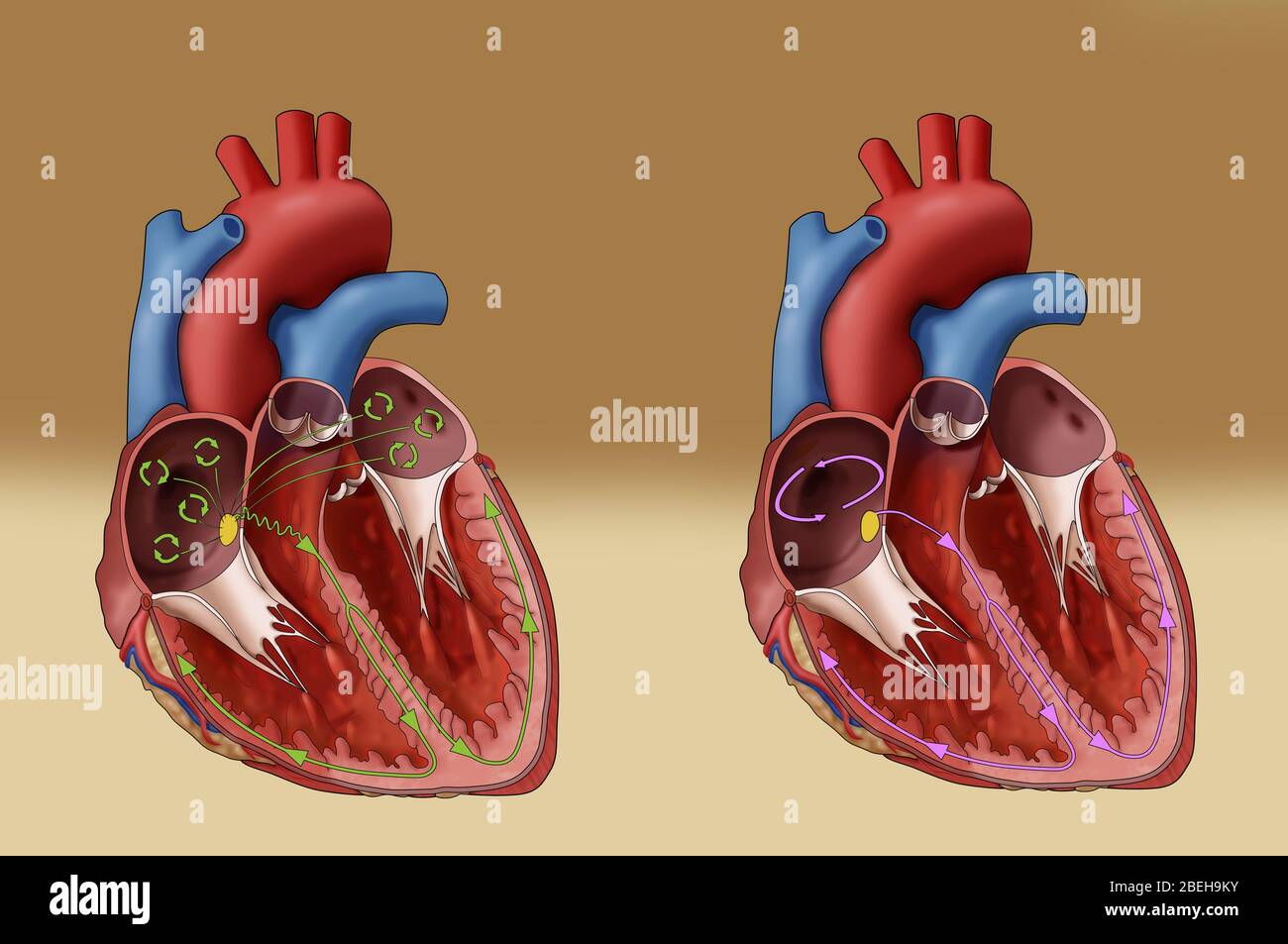 Fibrillation et flutter atriaux, illustration Banque D'Images