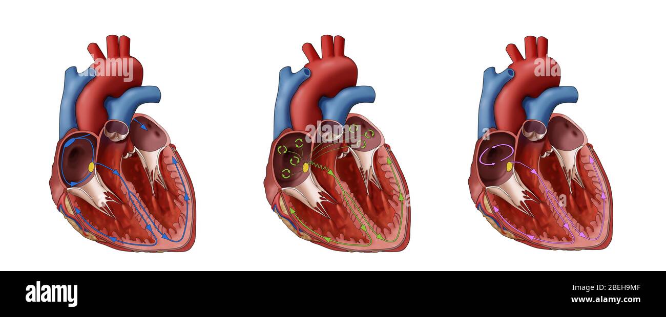 Coeur, Fib et Flutter auriculaire, Illustration Banque D'Images