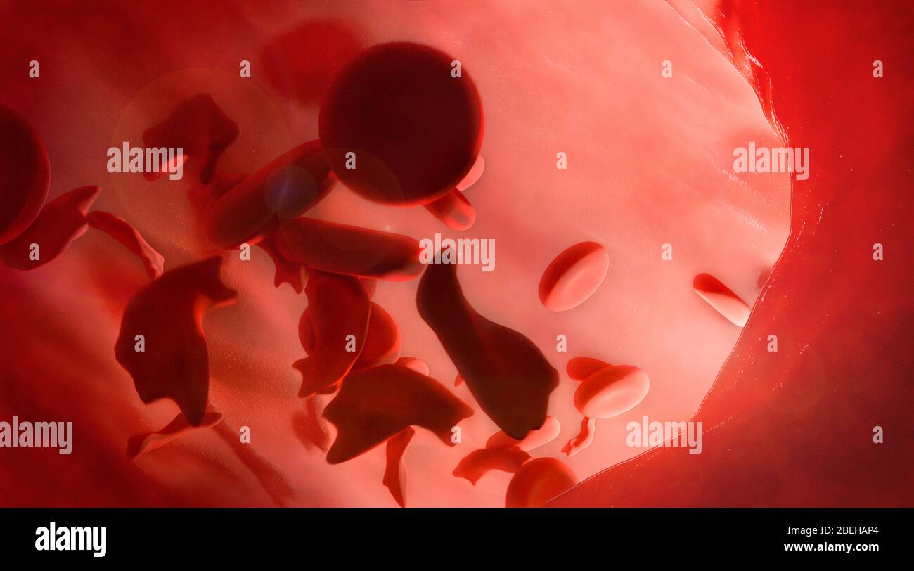 Illustration de la maladie de la faucille Banque D'Images