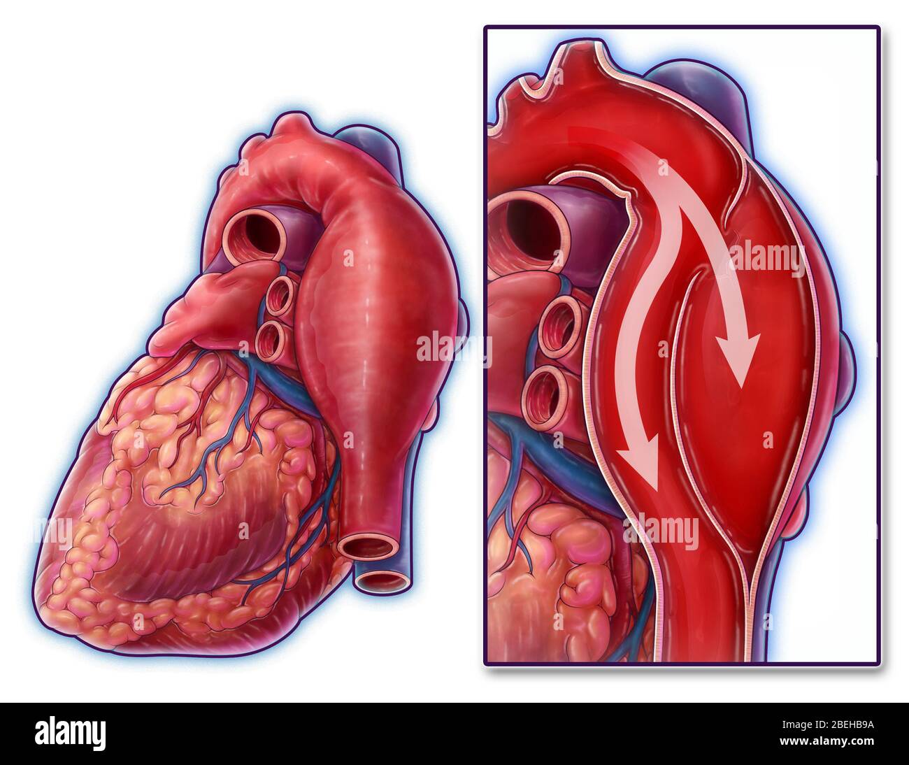 Dissection aortique, illustration Banque D'Images