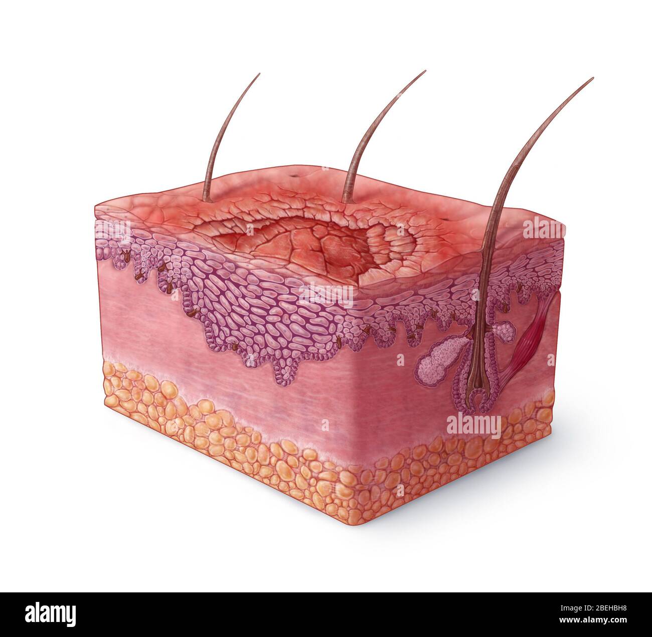 Illustration du carcinome épidermoïde Banque D'Images