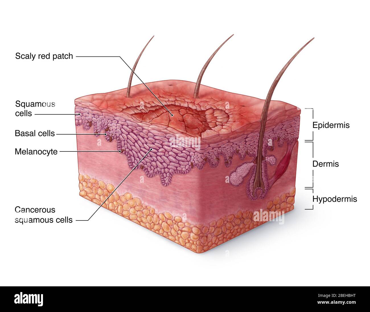 Illustration du carcinome épidermoïde Banque D'Images