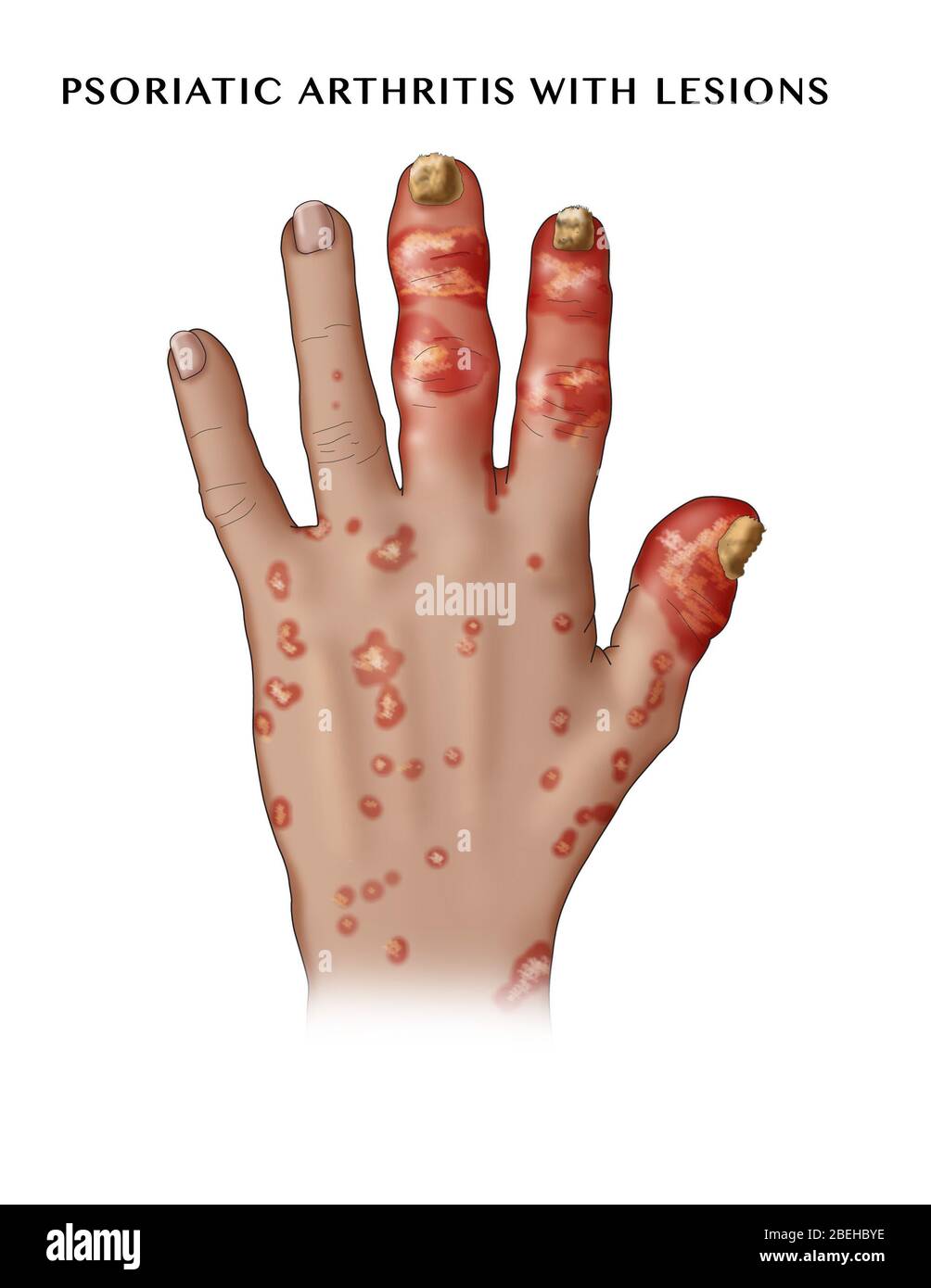 Arthrite, rhumatisme - Formule C2