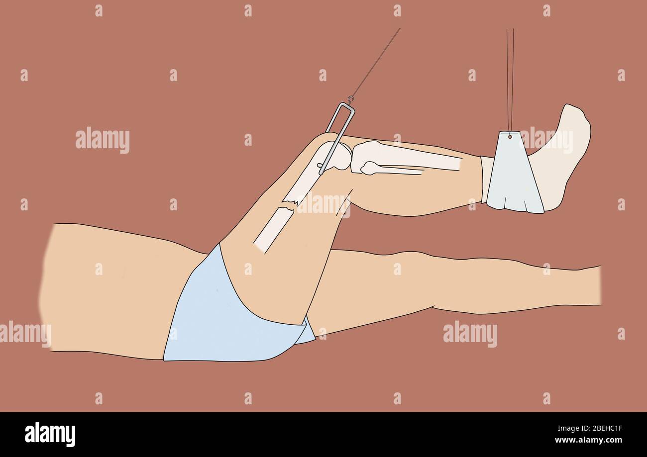 Fémur cassé en traction Banque D'Images