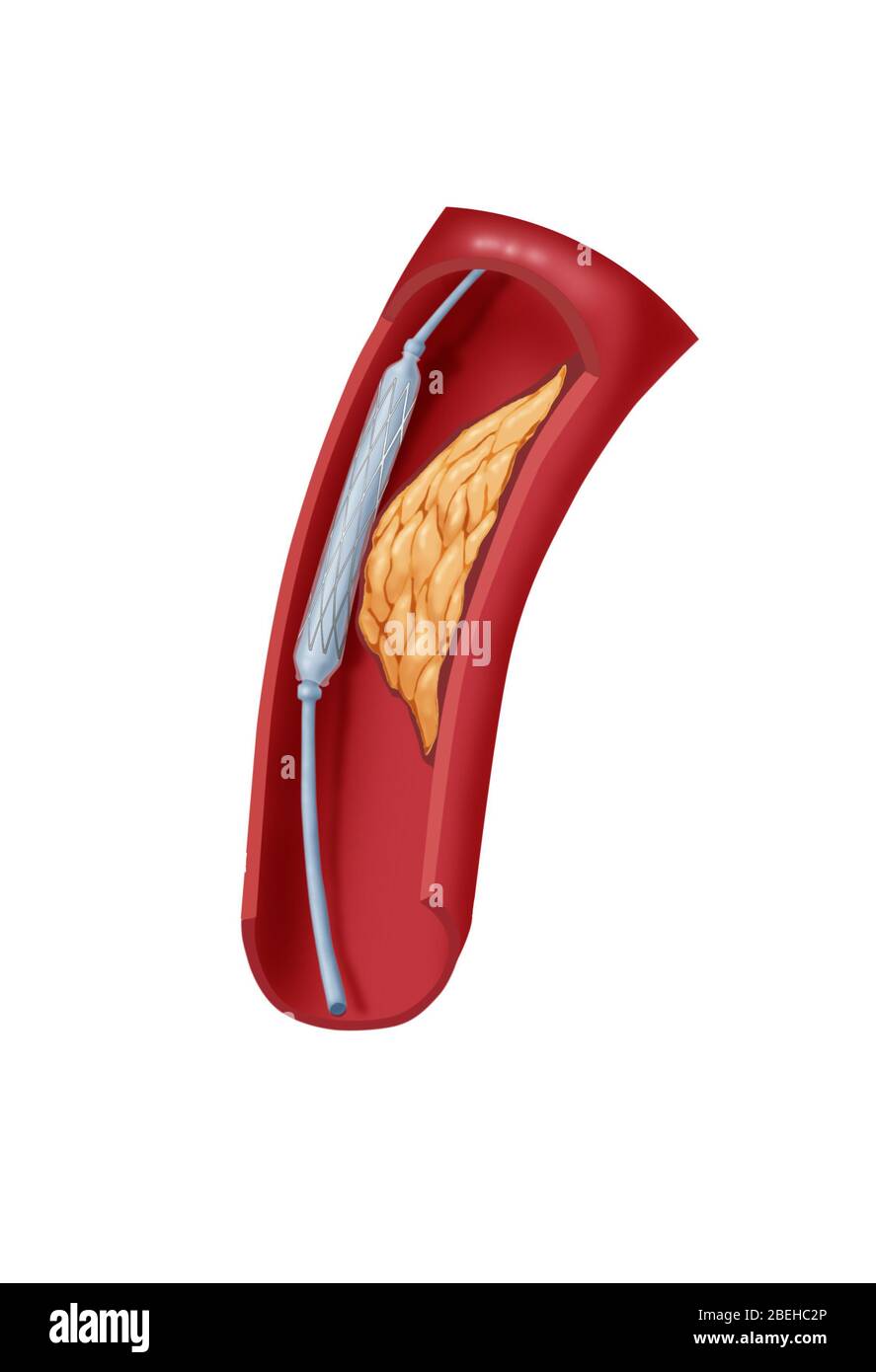 Angioplastie avec stenting, 1 sur 4 Banque D'Images