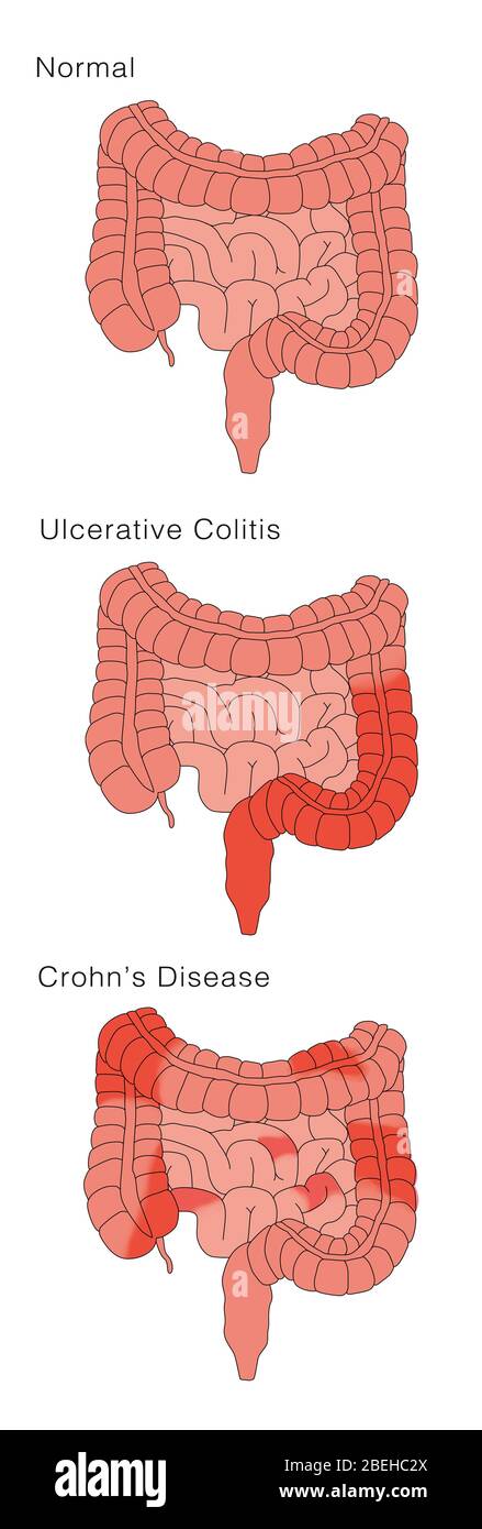 Maladie de Crohn et colite ulcéreuse, comparaison Banque D'Images
