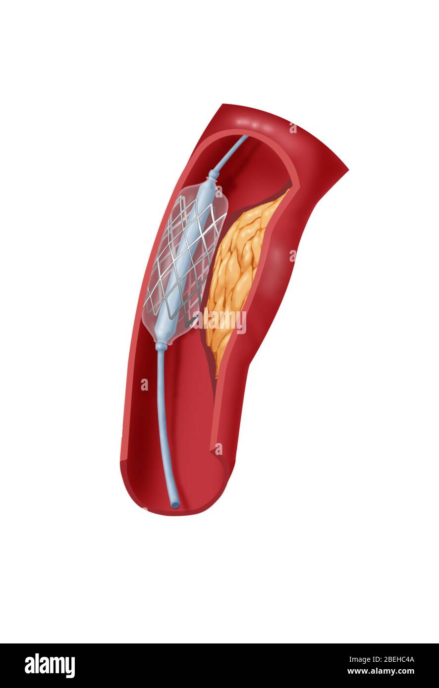 Angioplastie avec stenting, 2 sur 4 Banque D'Images