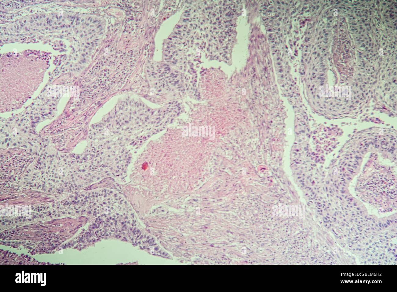 Carcinome épidermoïde des tissus malades sous le microscope 100 fois Banque D'Images