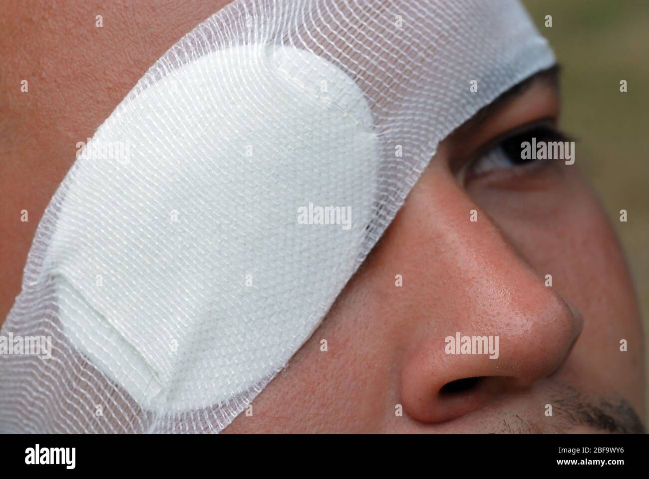 Ectropion Banque D Image Et Photos Alamy
