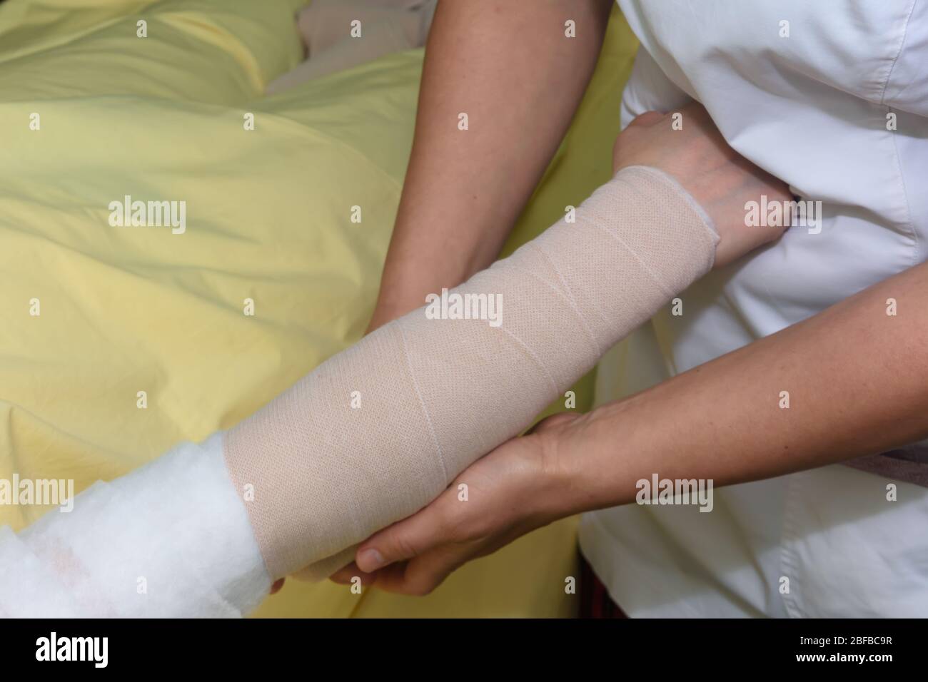 Gestion du lymphœdème : enveloppement de la main et du bras de lymphœdème à  l'aide de bandages multicouches pour contrôler le lymphœdème. Partie de la  thérapie décongestive complète (cdt) A Photo Stock -