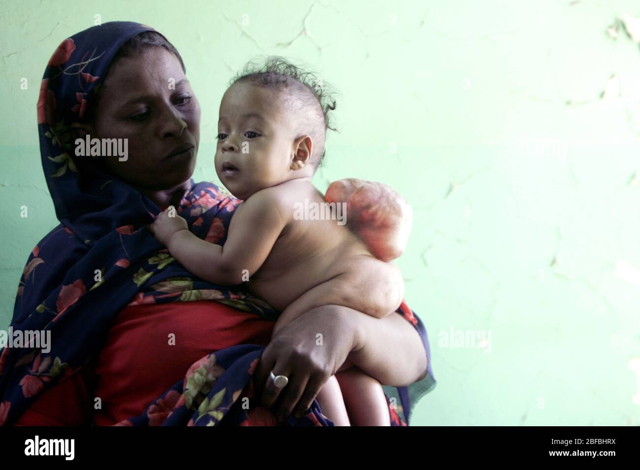 Une Mere Tient Son Bebe De 5 Mois Ne Avec La Meningomyelocele C Est Un Type De Spina Bifida Une Sorte De Defaut De Naissance Dans Lequel Le Canal Spinal Et Photo Stock