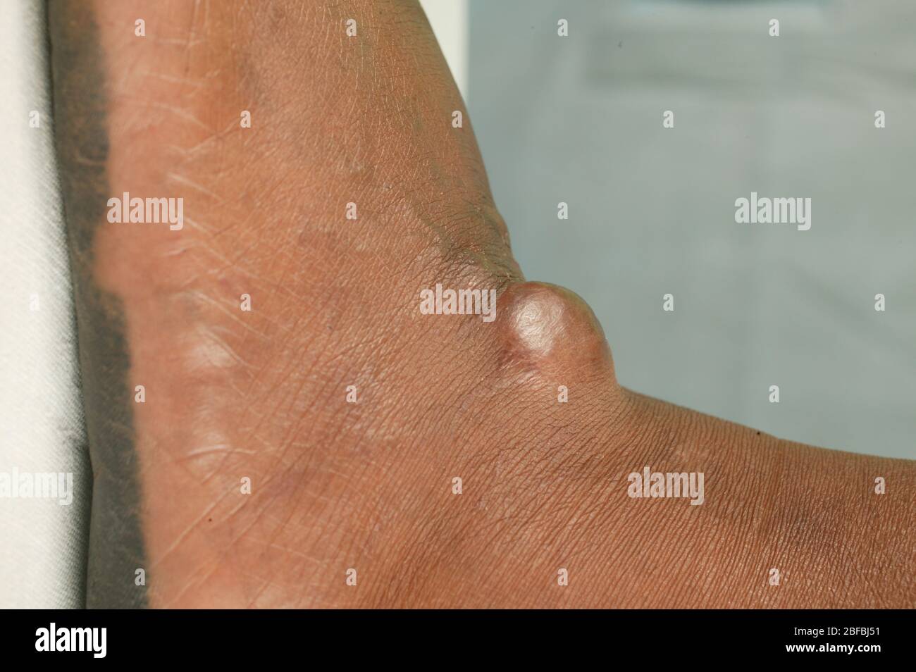 Kystes Banque D Image Et Photos Alamy Kystes Banque D Image Et Photos Alamy