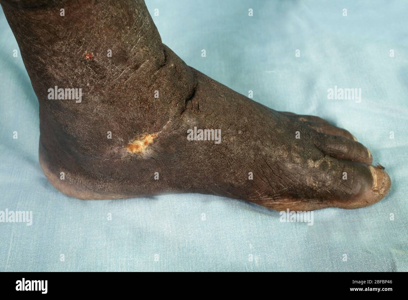 Varices avec complications du pied. Les varices se produisent dans les jambes en raison de valves incompétentes dans les veines tributaires reliant le profond et le supe Banque D'Images