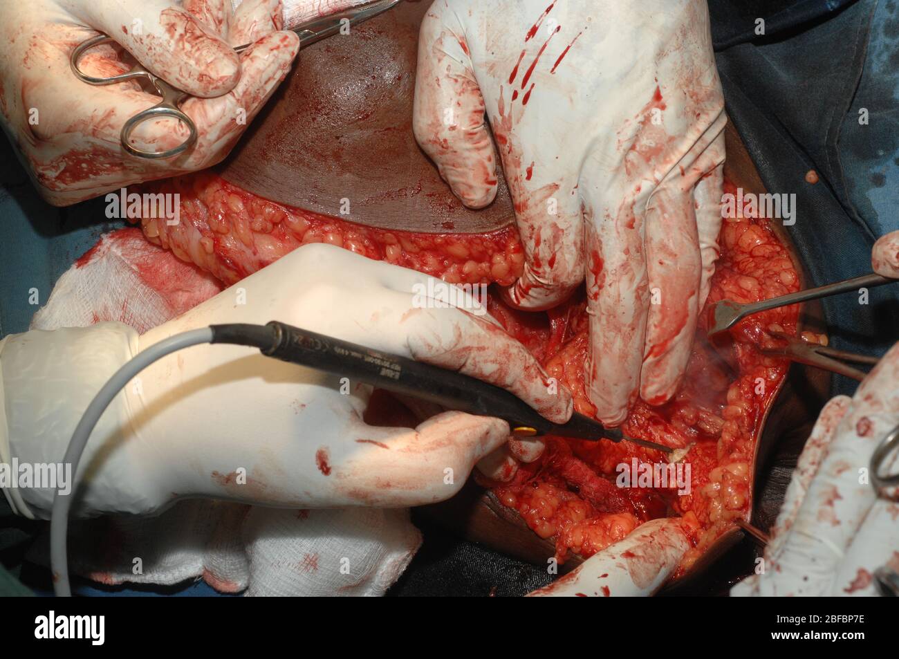 Suppression de l'axilla des ganglions lymphatiques contenant des secondaires. (Mastectomie + clairance axillaire) Banque D'Images