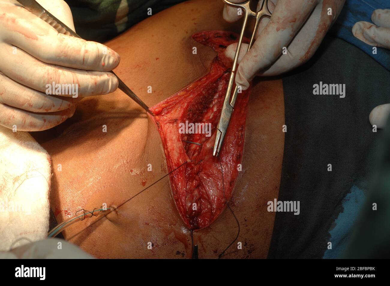 Les chirurgiens ont surclassé la zone abdominale d'un patient après une splénectomie. Banque D'Images