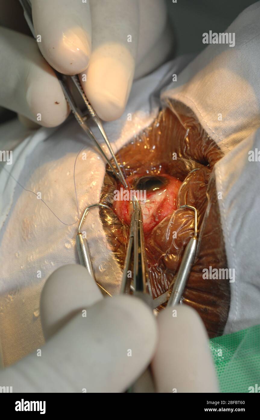 Une suture est placée dans la sclera. Il sera utilisé pour fixer la base de la canule de perfusion. Banque D'Images