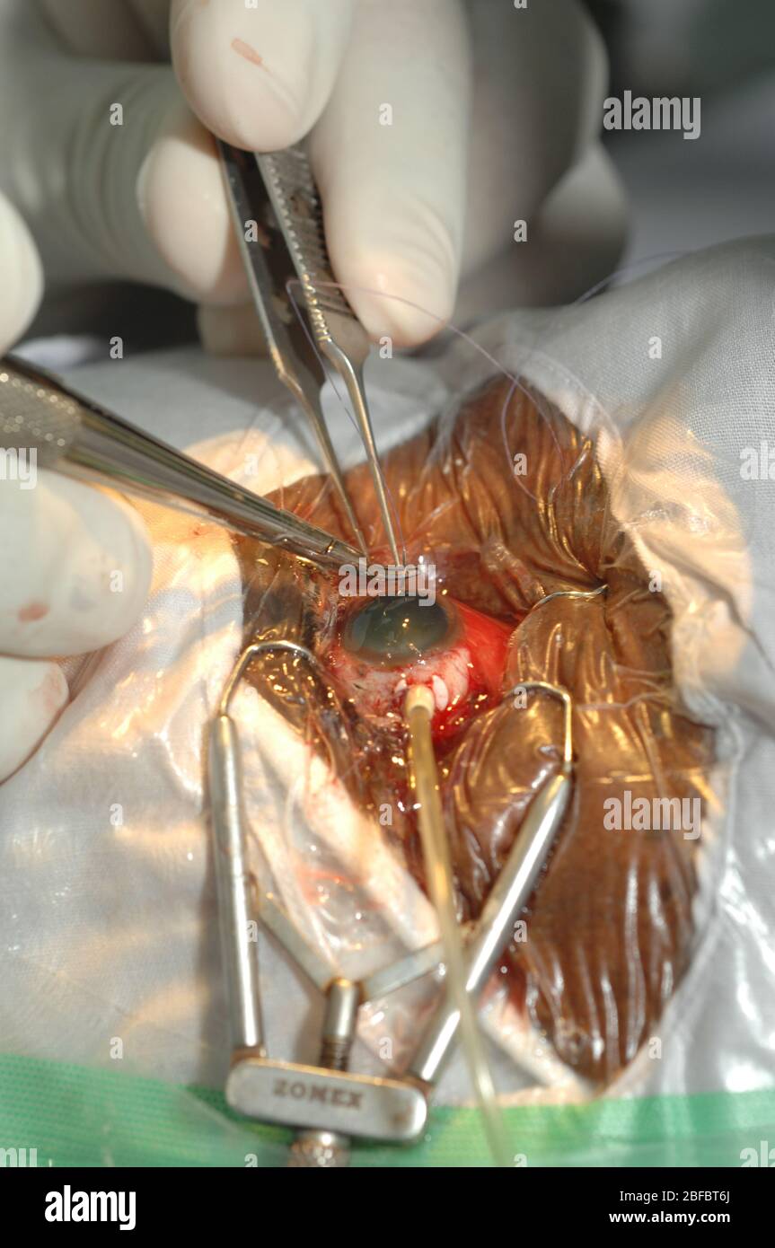 De petites sutures interrompues sont placées dans la sclérera pour fermer les incisions faites pour les instruments. L'incision suronasale est fermée en premier. Banque D'Images