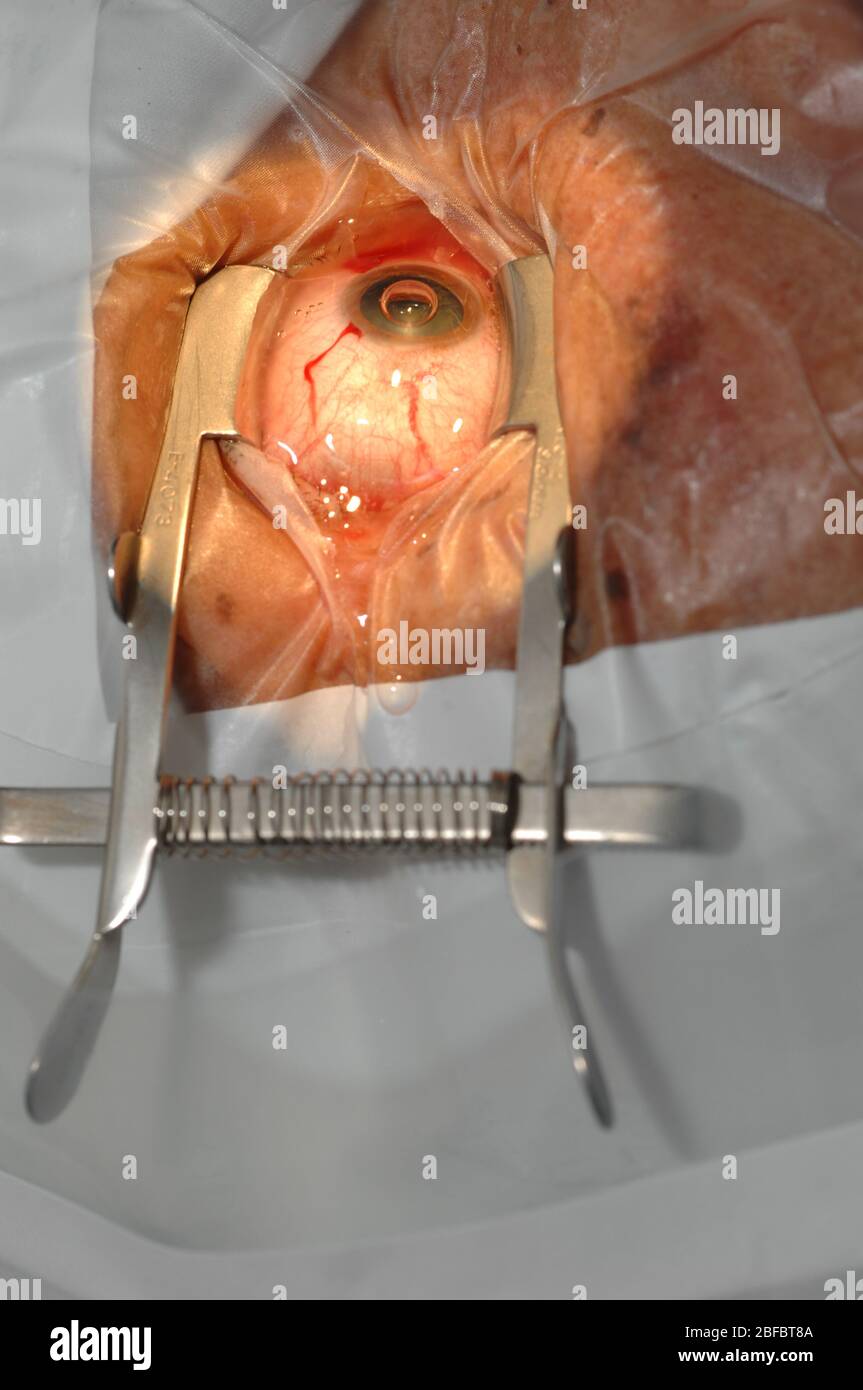 L'adrénaline peut être vu travailler comme l'élève a dilaté malgré les lumières chirurgicales lumineuses directement sur elle. Banque D'Images