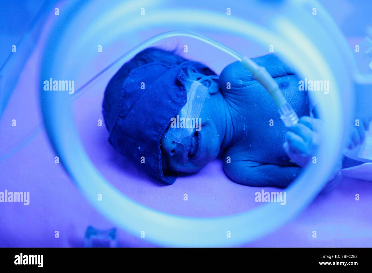 Bebe Premature Dans Un Incubateur Sous Phototherapie Pour Traiter La Jaunisse La Jaunisse Est Causee Par Le Depot D Un Exces De Pigment Bilirubine Dans La Peau Photo Stock Alamy Bebe Premature Dans Un Incubateur Sous Phototherapie Pour Traiter La Jaunisse La Jaunisse Est Causee Par Le Depot D Un Exces De Pigment Bilirubine Dans La Peau Photo Stock Alamy