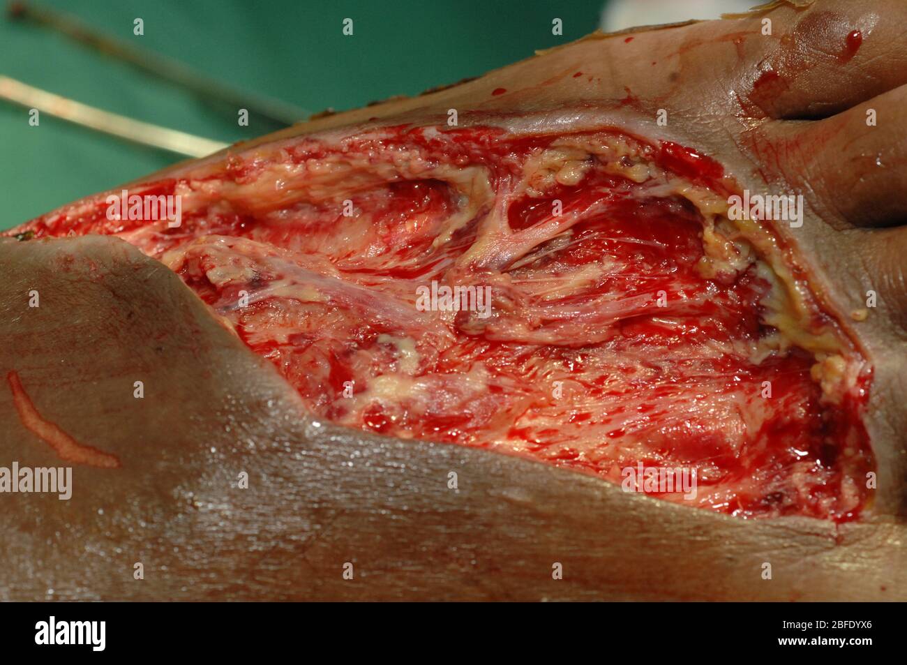 Gros ulcère diabétique sur le pied gauche d'un patient diabétique. Les ulcères du pied sont un risque commun pour les personnes souffrant de diabétiques en raison d'un sang insuffisant Banque D'Images