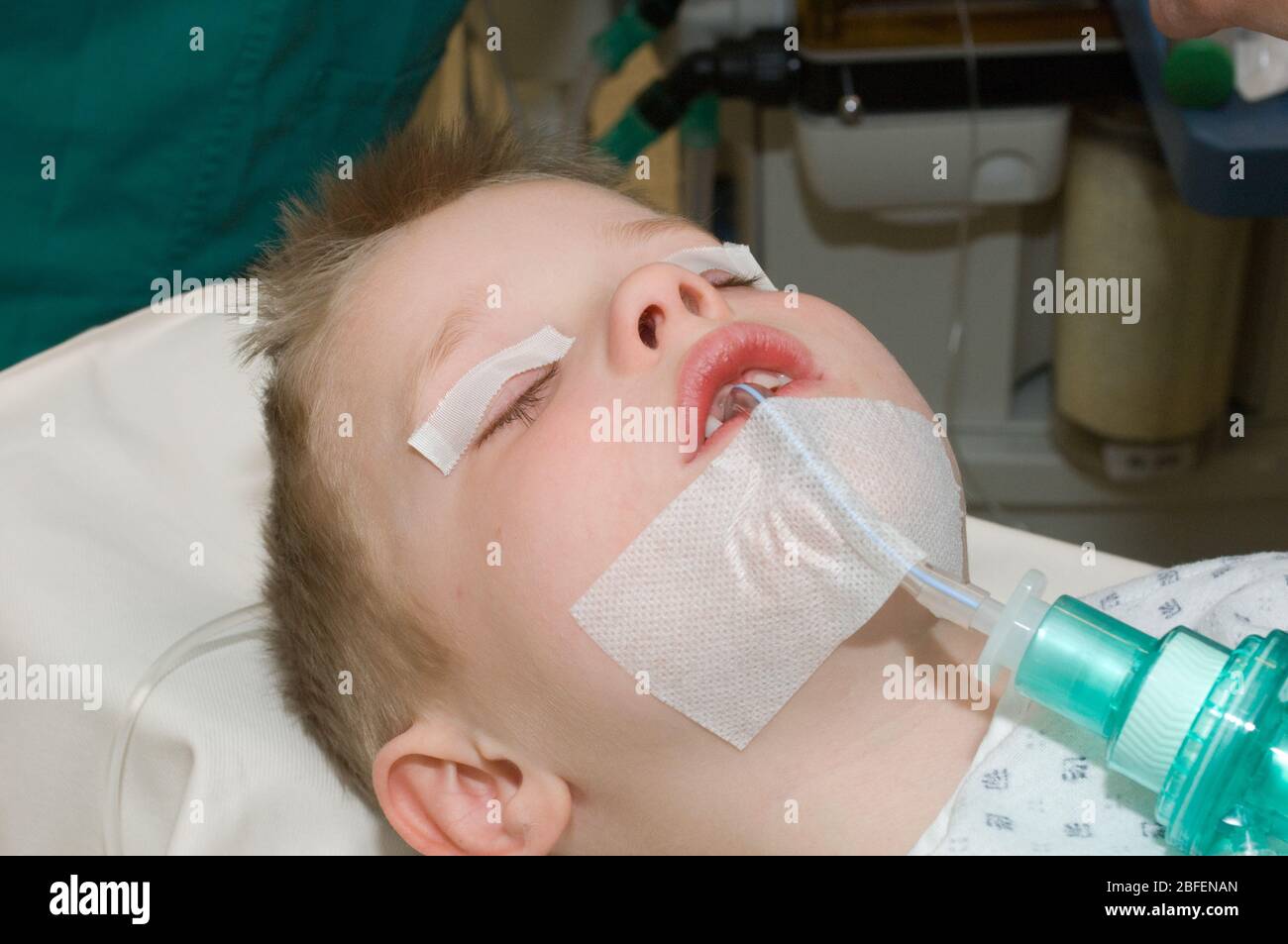 Jeune enfant portant un tube de trachéostomie pendant l'utilisation Banque D'Images