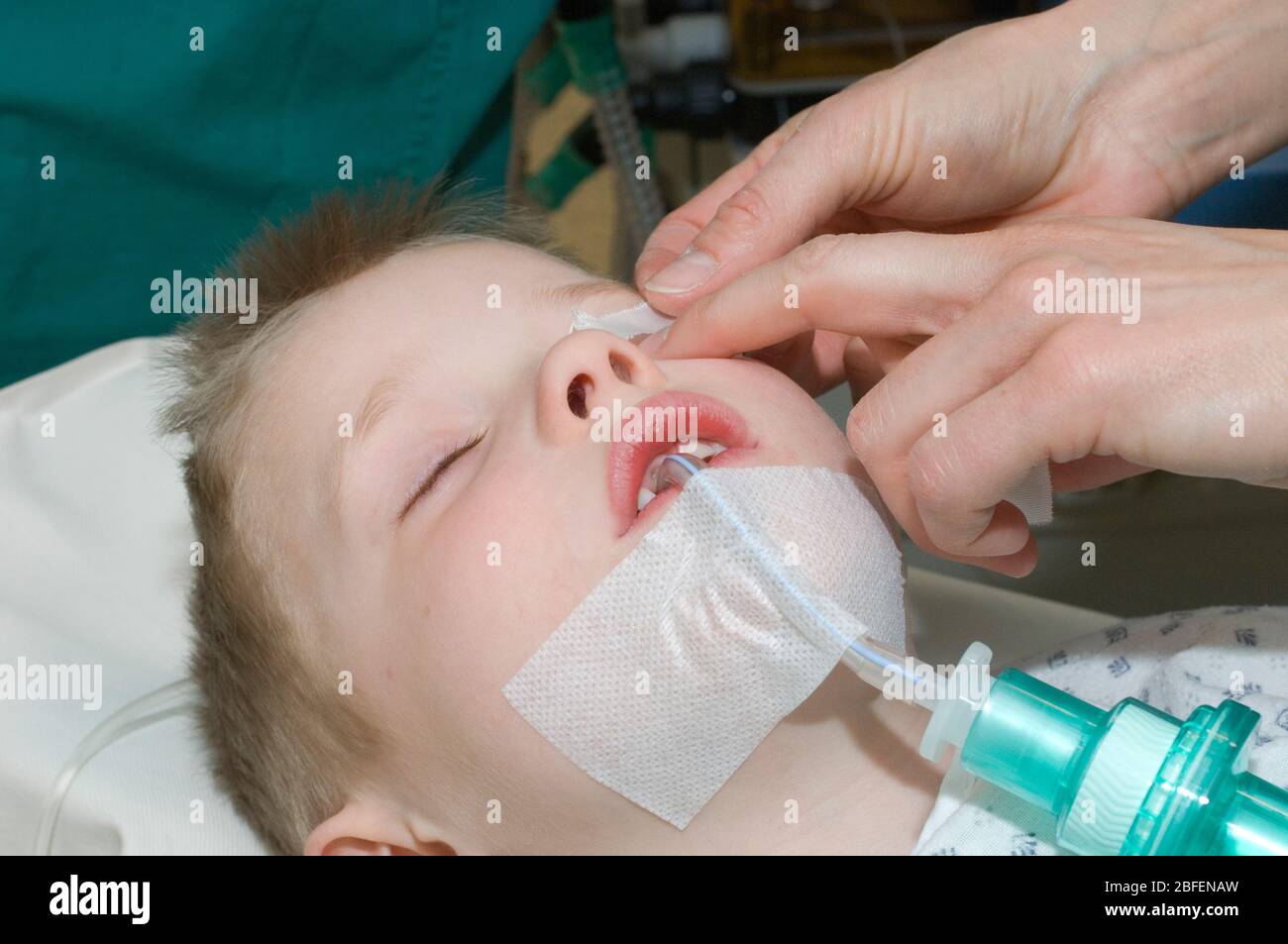 Jeune enfant portant un tube de trachéostomie pendant l'utilisation Banque D'Images