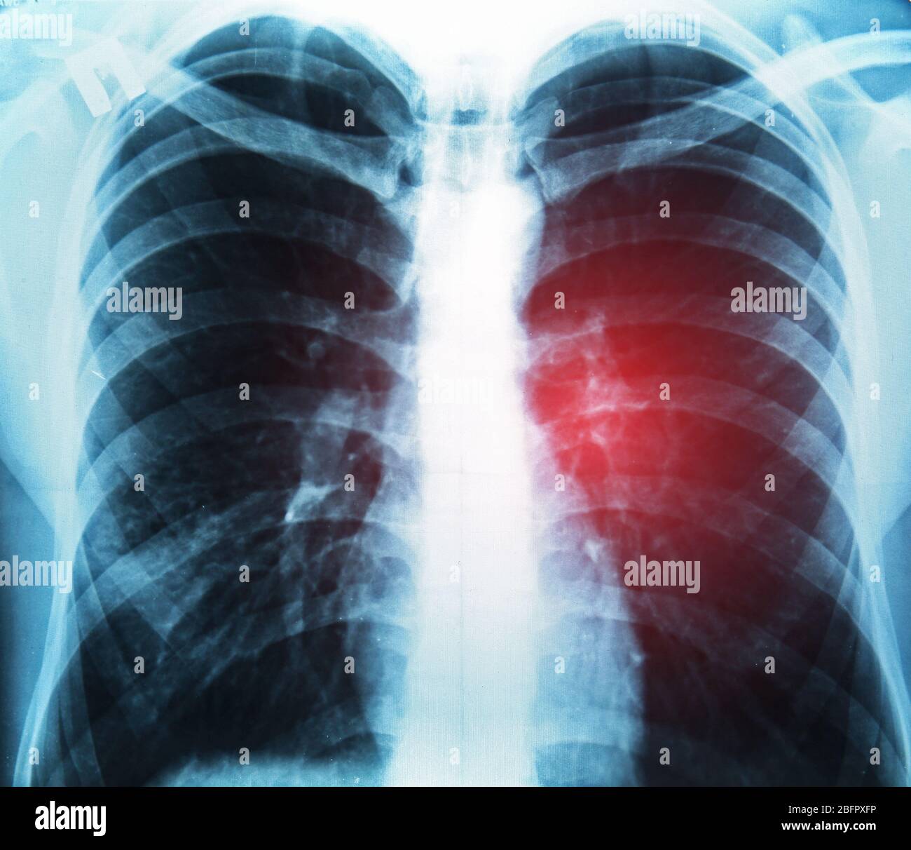 Image radiographique de la poitrine. Concept de cancer du poumon Banque D'Images