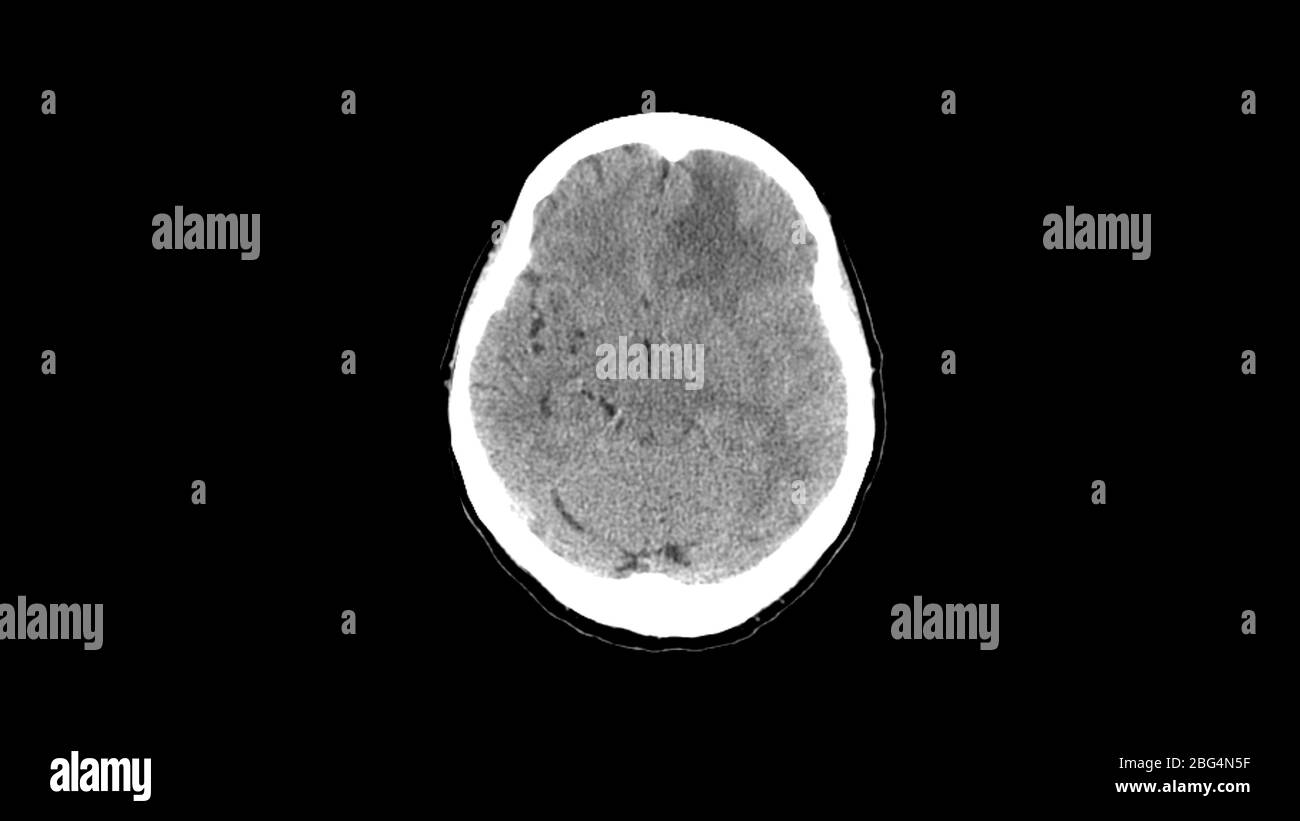 IRM du cerveau avec hématome. Acquisition d'imagerie par résonance magnétique réelle. Banque D'Images