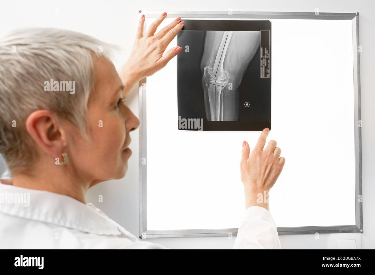 Le radiologue a examiné une radiographie du genou sur un négatoscope. le médecin voit une jambe meurtrie sur une radiographie Banque D'Images